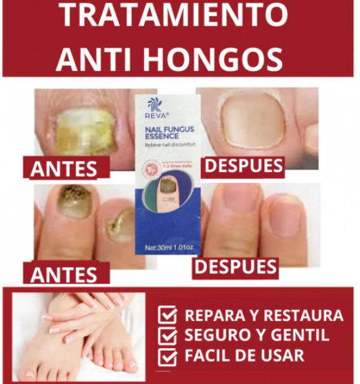 GEL ANTI HONGOS UÑAS