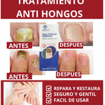 GEL ANTI HONGOS UÑAS