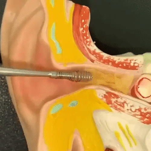 ¡ByeCera Pro!® – Kit para Limpieza de Oídos